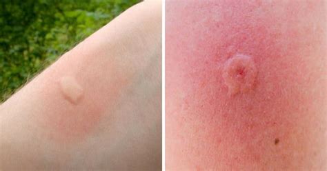The blister may rupture and form a skin ulcer that later scars. Itchy skin in the bite area or all over the body. Hobo spider bites rarely cause pain. Signs of a hobo spider bite include: Severe headache within minutes or hours after the bite. This headache may last for a week. Hardened skin in the bite area within 30 minutes of the bite. 